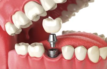 Lower jaw single implant.