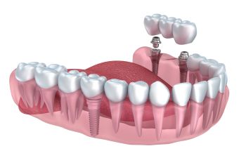 Implant Supported Dental Bridge